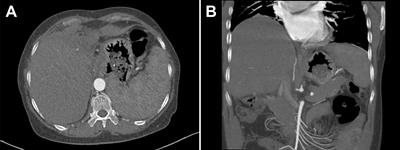 Case Report: Interventional therapy for portal venous stenosis caused by systemic vasculitis